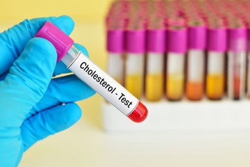 Blood sample for cholesterol test

