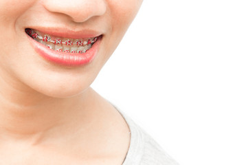 Obraz premium Close up woman smiling with Ceramic and Metal Braces on white ba