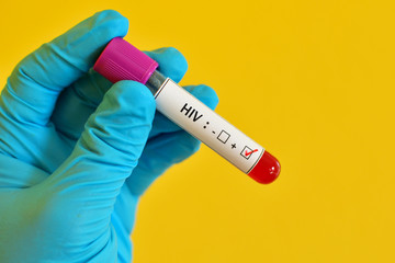 Obraz premium Blood sample positive with HIV test 