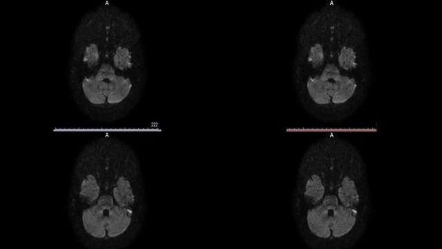 Magnetic resonance imaging sclerosis microstroke white spots in the brain