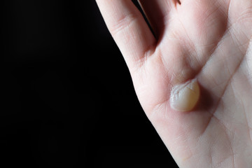 human palm with blister on skin