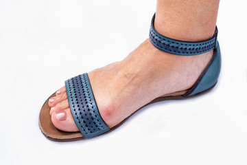 The problem with bunions and footwear