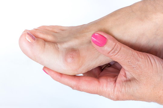women hand holding the foot with painful bunion
