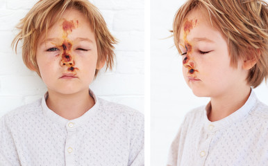 soft tissue contusion, extensive edema of young boy face, as a result of a fall from a bicycle