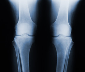 Xray knee joint