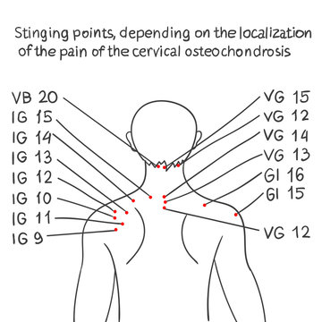 Stinging points, depending on the localization of the pain of th