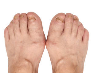 a toenail fungus