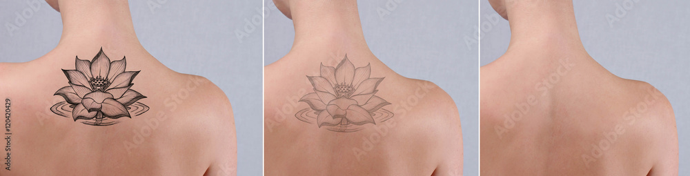 Wall mural laser tattoo removal before and after. beautiful young woman with tattoo on her back