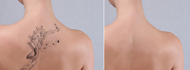 Laser tattoo removal before and after. Beautiful young woman with tattoo on her back