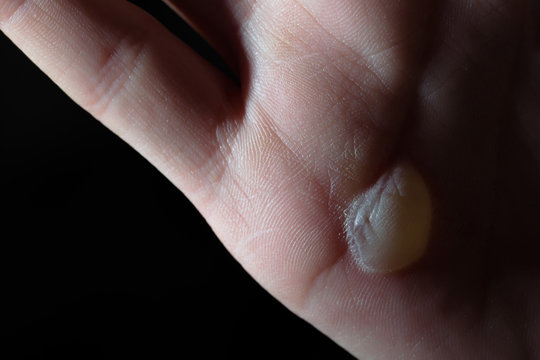 human palm with blister on skin