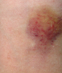 Fototapeta premium Bruised Skin