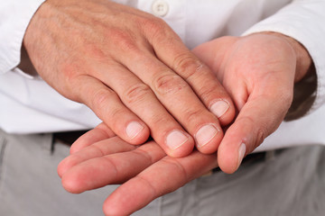 Male hands with dry skin. Dermatology, cold weather skin care concept