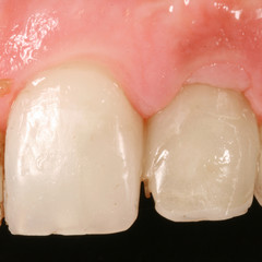 dental surjery implant view