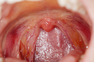 tonsilitis infection throat.macro opened mouth  throat  tonsil