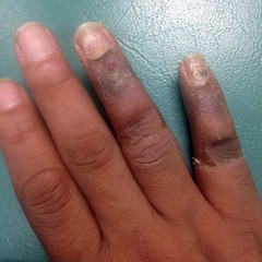 Infectious wound on finger