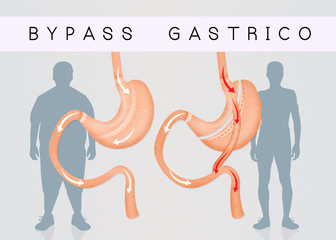 gastric bypass to reduce stomach - obrazy, fototapety, plakaty