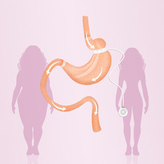 gastric band to reduce stomach