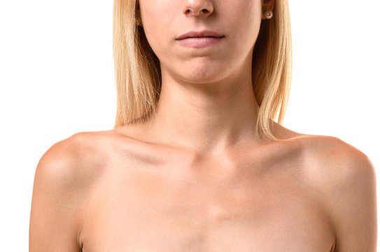 Protruding collar bones of an anorexic young woman