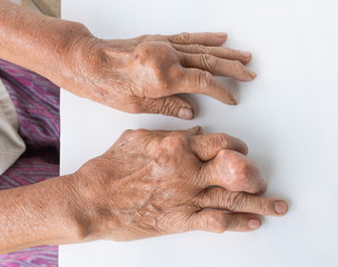 Fototapeta premium hands of gout patient