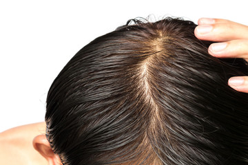 Closeup young man serious hair loss problem for hair loss concep