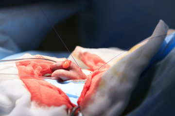 Piece of rectum with a tube passing though and surgical thread strained