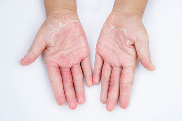 Dry hands, peel, Contact dermatitis, fungal infections, Skin inf