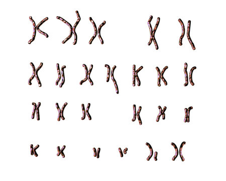 Philadelphia chromosome karyotype male or female. 3D illustration showing defective 9 and 22 chromosomes with translocational defect which causes cause chronic myelogenous leukaemia