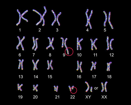 Philadelphia chromosome karyotype