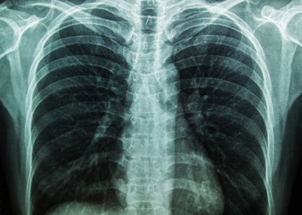 X-Ray Image Of Human Chest for a medical diagnosis