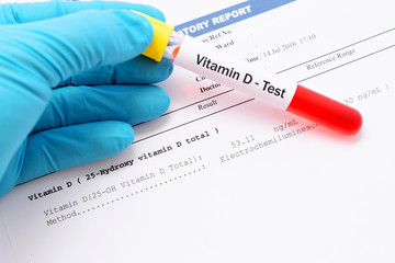 Vitamin D testing result with blood sample