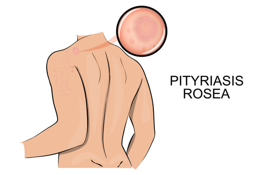 the skin affected by ringworm pink. pityriasis rosea.