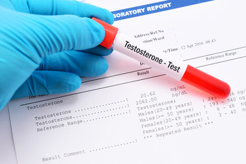 Blood sample for testosterone hormone test with result