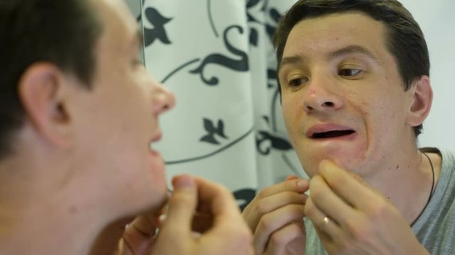 Man with Problem Skin queezing pimples