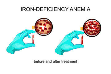 blood in vitro. red blood cells for iron deficiency anemia