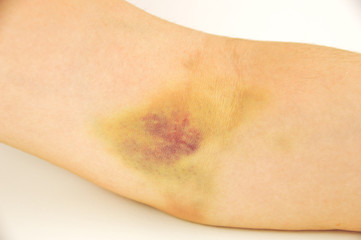 bruise in the arm