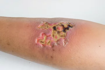 Fotobehang Serious open wound on a skin from hot water scald © chatuphot