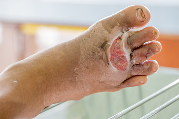 infected wound of diabetic foot