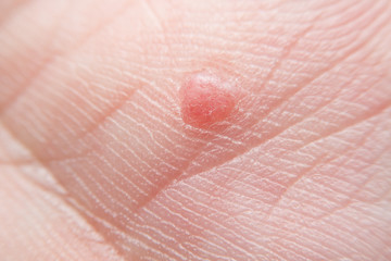 Red mole on hand