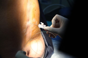 epidural anesthesia