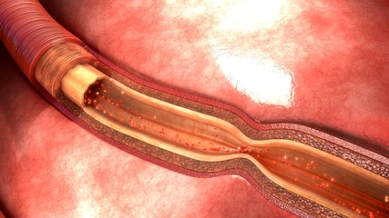 Artery Spasm