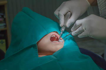 Dental, dentist using dental elicited teeth. Extracting a tooth