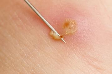 abscess with pus on the skin