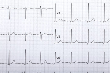 electrocardiogram