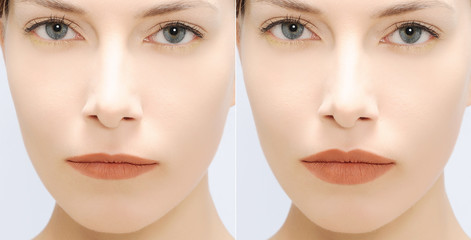 woman fill lips - before and after