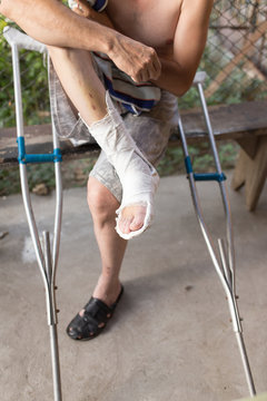 broken leg in a cast male