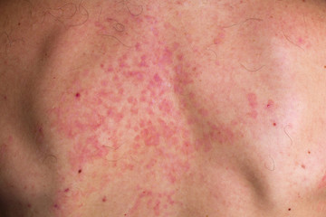 Skin fungus on his back. Red spots on the backs of men. Mold.