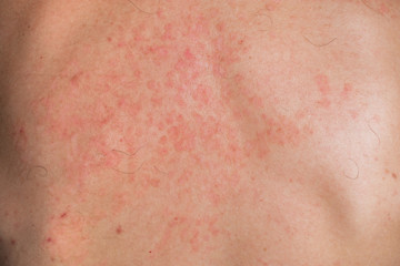Skin fungus on his back. Red spots on the backs of men. Mold.