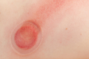 Fototapeta premium Human back, receiving vacuum cupping massage