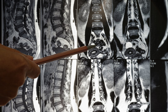 Spine x-ray film