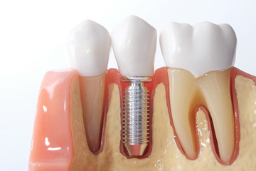 Naklejka premium Generic dental teeth model